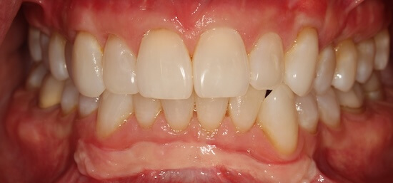 Alloderm After