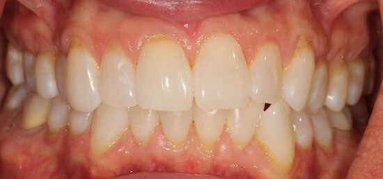 Alloderm Before