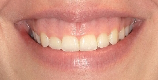 Heather Before