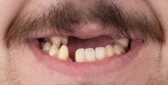 Justin before