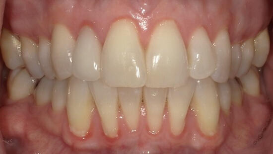 Justina Before