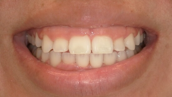 Karina Before