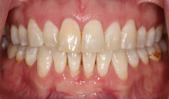 Laurel After