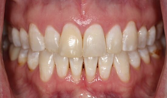 Laurel Before