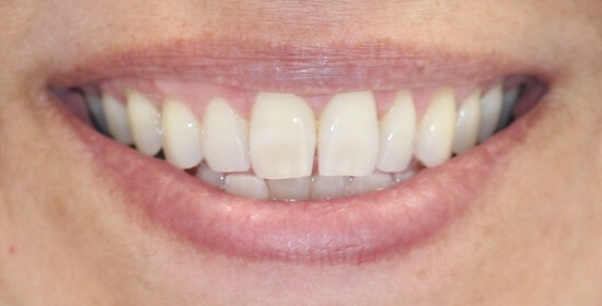 Melinda After