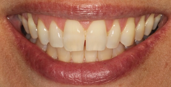 Melinda Before