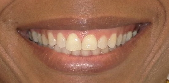 Nicole Before