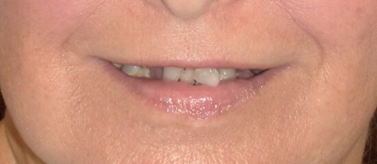 Teresa Before