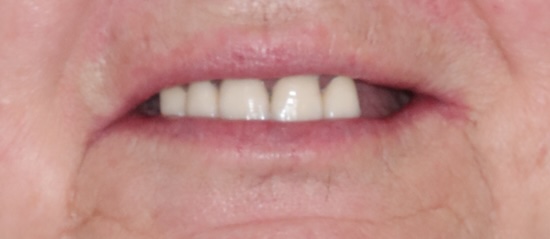 Yoli Before
