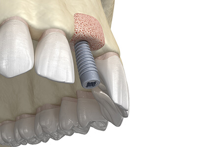 Implant13